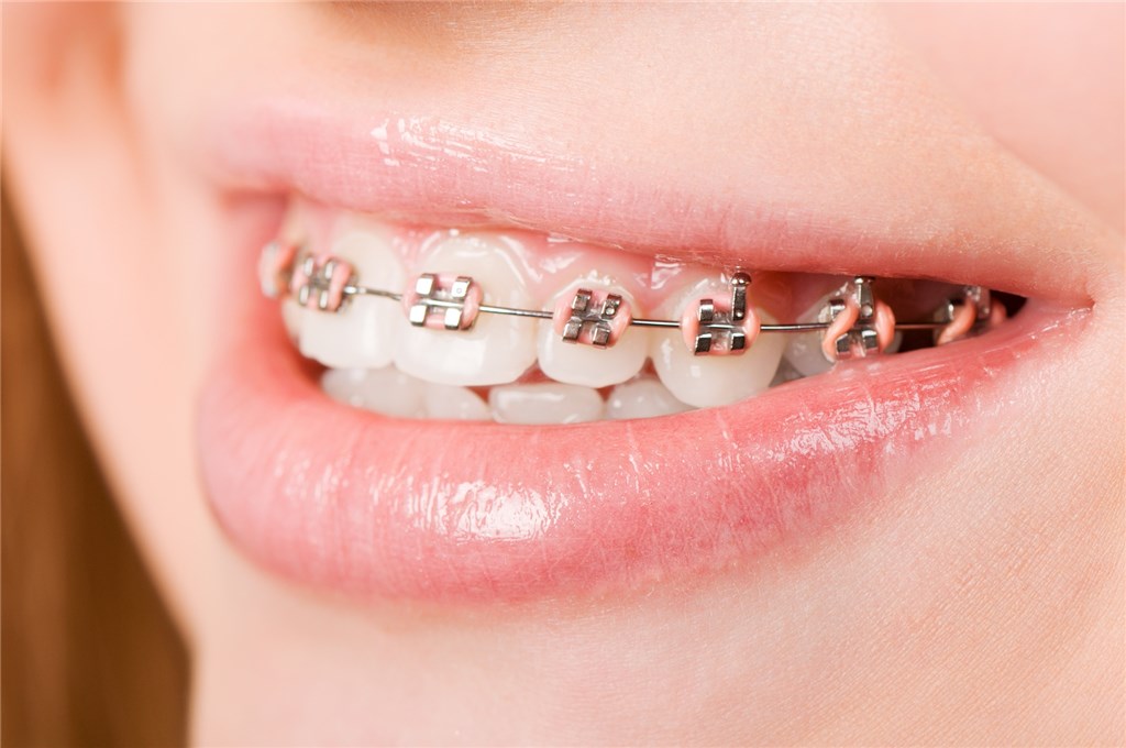 歯の矯正治療